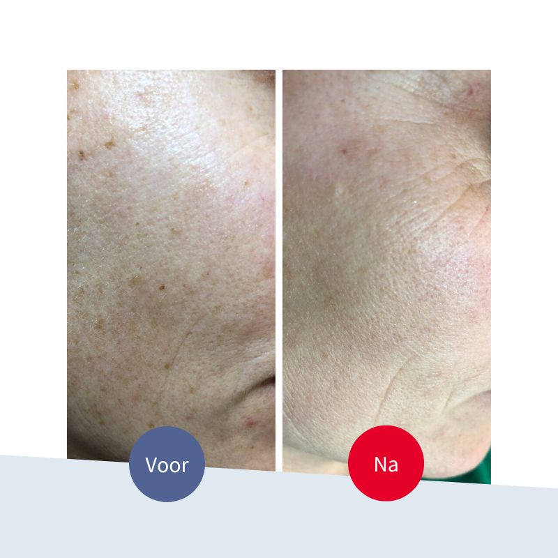 Jouw-Huidtherapeut-voorbeeld-pigmentvlekjes-ouderdomsvlekjes-behandelen-lasertherapie-pigmentlaser-donkere-vlekjes-op-je-huid-wang-gezicht-resultaat-voor-na