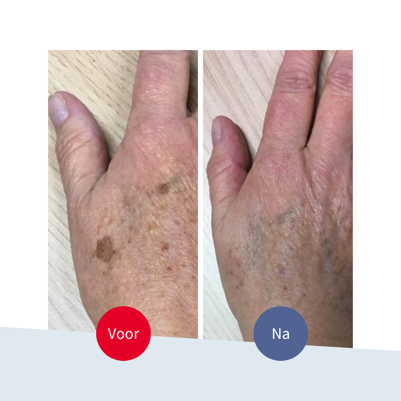 Jouw Huidtherapeut - voor en na - cryotherapie - resultaat - pigmentvlekken ouderdomsvlekken handen