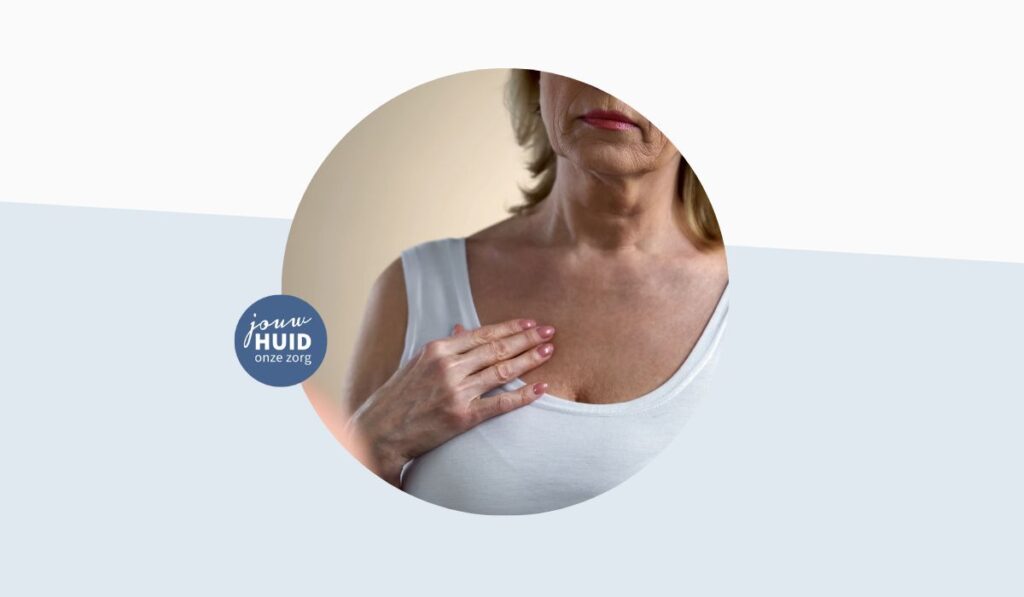 Jouw Huidtherapeut - blog - huidklachten bij vrouwen van middelbare leeftijd - ouderdomswratjes - decollete